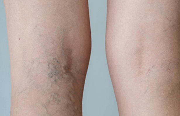 Are Your Spider Veins Trying To Tell You Something?