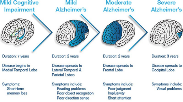 What are the Three Stages of Alzheimer’s Disease
