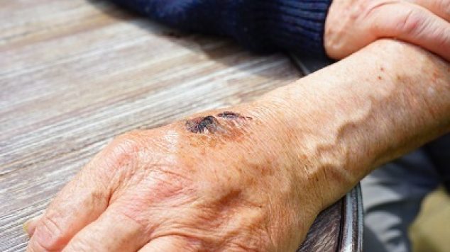 The Dangers of Pressure Sores Among Nursing Home Residents